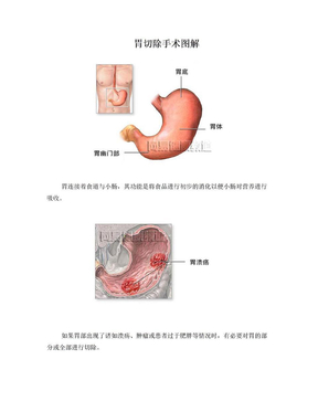 胃切除手术图解