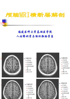 颅脑MRI横断层解剖
