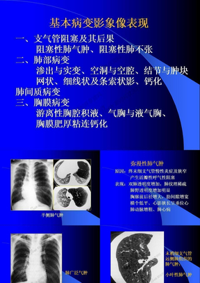 肺部基本病变影像表现