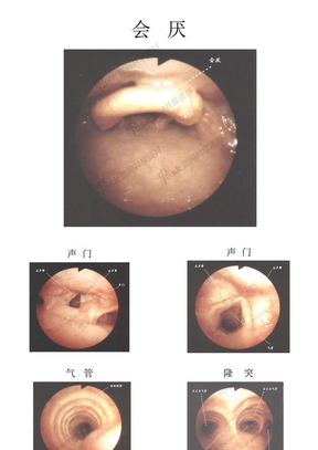 气管镜图谱各段辨认图片