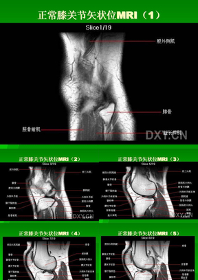 膝关节MRI解剖
