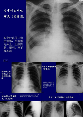 肺部常见病变