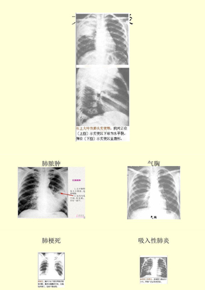呼吸系统疾病典型
