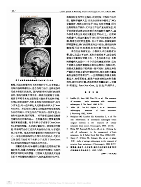 脑转移瘤的立体定向放射手术_附272例临床报告_