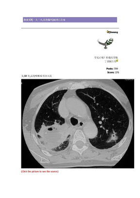 肺部CT　CA