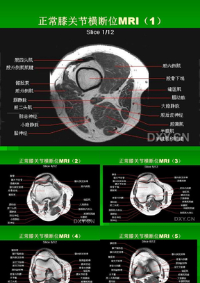 膝关节MRI横断位