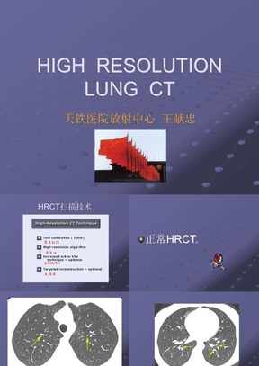 高分辨率肺部CT