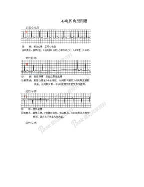 心电图典型图谱