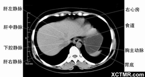 腹部盆腔CT