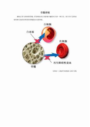 骨髓移植