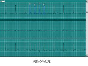 房性心动过速